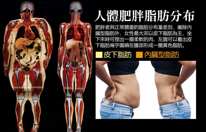 腰腹抽脂常识详解：皮下脂肪与内脏型脂肪