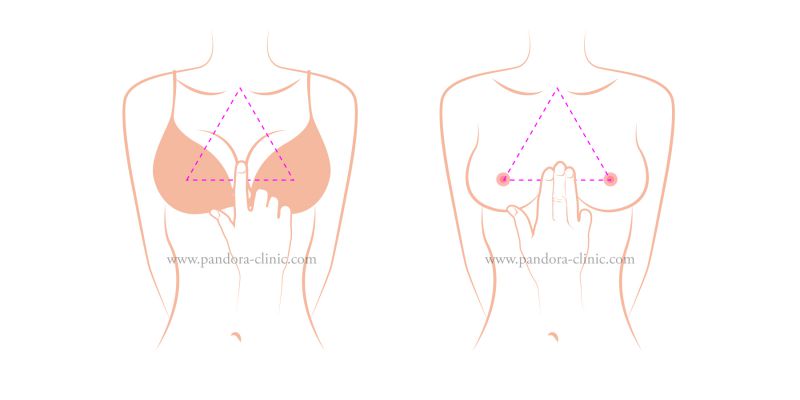 隆乳手术切口在哪里最好？隆胸手术切口优缺点及其胸型分析