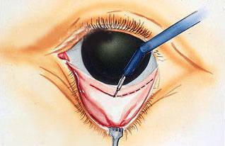 内开法外切法祛下眼袋手术方式和注意事项