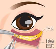 内开法外切法祛下眼袋手术方式和注意事项