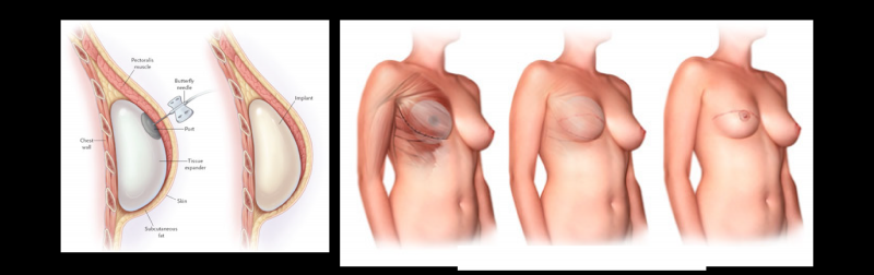 胸部下垂怎么办？提乳（乳房上提）手术适用者和注意事项常识