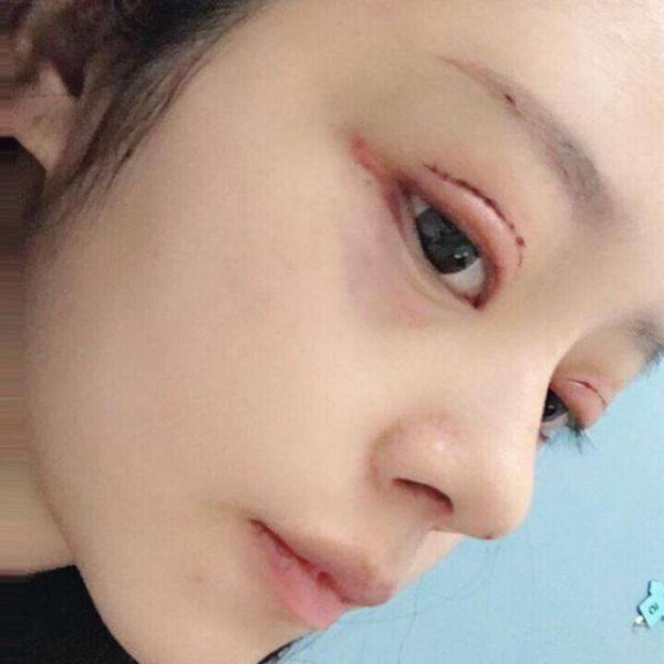 台湾整形专家有关双眼皮手术方法的迷思