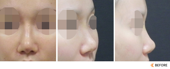 隆鼻手术失败之鼻骨穿出后的鼻雕重置修复手术