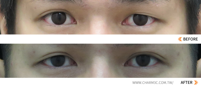 双眼皮折痕〈重睑线〉消失或变的不明显怎么修复？