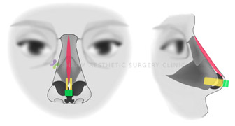隆鼻失败之二次手术后造成的鸟嘴鼻型怎么修复？