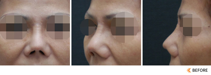 隆鼻失败之多次鼻整形手术后的朝天猪鼻子怎么修复？