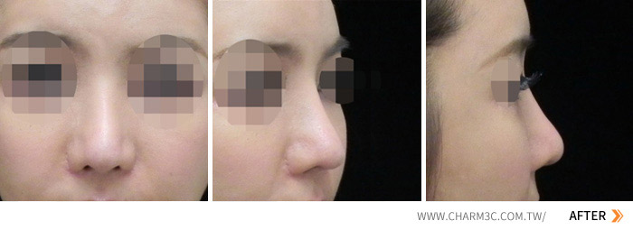 隆鼻失败之鼻雕手术后的鼻头凹凸不平及软骨凸出怎么修复？