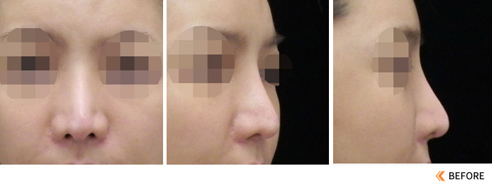 隆鼻失败之鼻雕手术后的鼻头凹凸不平及软骨凸出怎么修复？