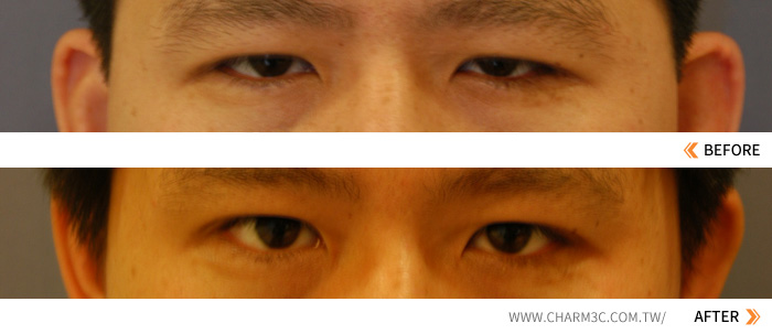 割双眼皮手术失败后出现"内双"的原因和修复方式有哪些？