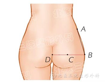 脂肪移植隆臀：如何拥有一颗完美翘臀？