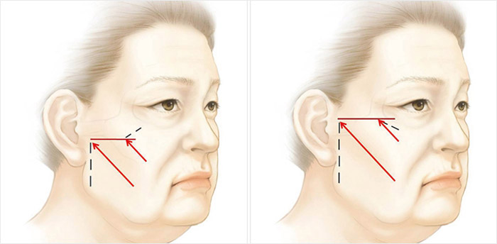 中面部老化四大问题:眼袋/泪沟,苹果肌凹陷,法令纹加深,脸颊/嘴角下垂