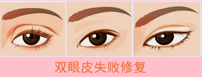 韩国双眼皮修复专家玄炅倍（案例预约效果）讲解双眼皮修复技巧