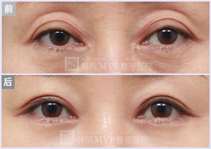 韩国双眼皮修复专家玄炅倍（案例预约效果）讲解双眼皮修复技巧