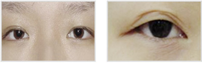 韩国双眼皮修复专家曹仁昌双眼皮修复（案例预约效果）价格多少钱？