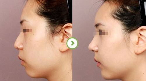 韩国顶级鼻整形专家：郑东学（案例简介价格预约）鼻综合怎么样？