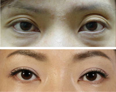 中国最厉害的顶级双眼皮修复专家：曹仁昌和洪星杓（简介案例预约）双眼皮修复谁厉害？