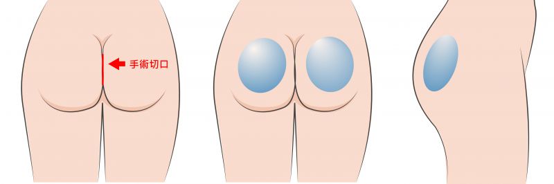丰臀提臀手术有哪几种方式？玻尿酸注射电波拉提人工丰臀脂肪丰臀