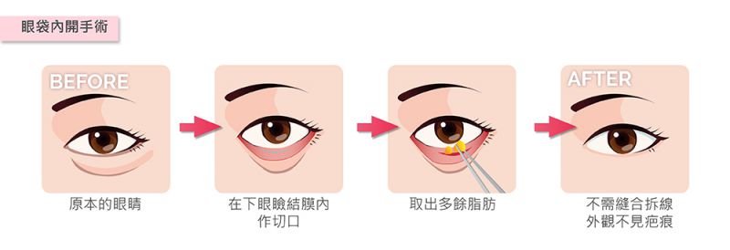 假如有眼袋的问题该怎么处理？有哪几种手术方式呢？