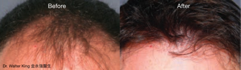 九成半男性秃头的主要原因是遗传性秃头 机械臂辅助植发简介