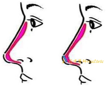 韩式隆鼻(L形隆鼻与韩式隆鼻)案例对比谁更好？