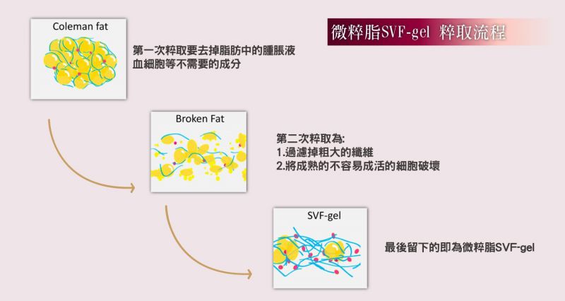 自体脂肪3.0：微粹脂SVF-gel ─ 什么是自体脂肪干细胞 