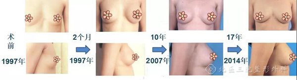 假体隆乳丰胸术后乳房出现松弛下垂假体老化、破裂等情况怎么办？
