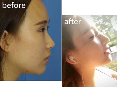 中国最好的隆鼻鼻修复专家：成铤（案例预约效果价格）在哪个医院坐诊？