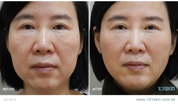 全脸提升：全脸拉皮手术埋线提拉和电波音波拉提哪个全脸提升效果最好？