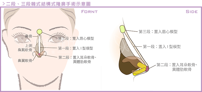 韩式结构式隆鼻=二段式隆鼻=鼻子的雕刻手术（传统隆鼻和韩式隆鼻对比）