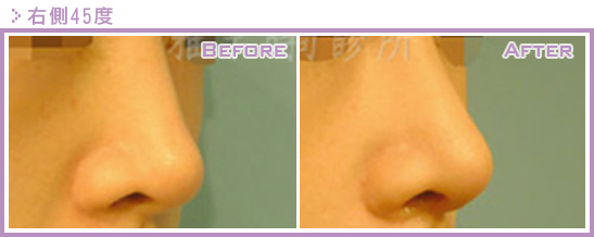 二次隆鼻手术（隆鼻修复、隆鼻重修）的原因是什么？鼻修复案例真实图片