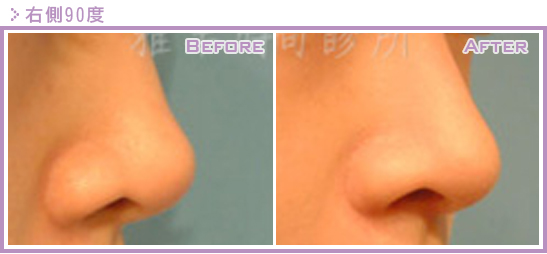二次隆鼻手术（隆鼻修复、隆鼻重修）的原因是什么？鼻修复案例真实图片