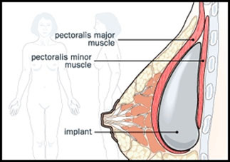 隆胸手术中常见的切口位置在哪里？假体隆胸假体一般放在哪个位置？