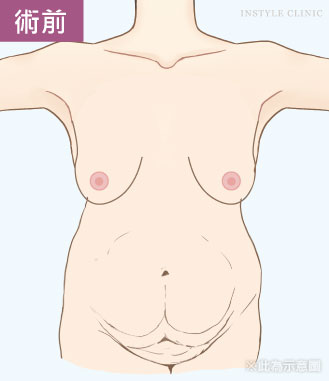 怀孕产后的腹部赘肉松弛和乳房下垂怎么办？腹部拉皮+隆胸TABA二合一