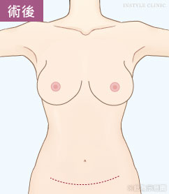 怀孕产后的腹部赘肉松弛和乳房下垂怎么办？腹部拉皮+隆胸TABA二合一