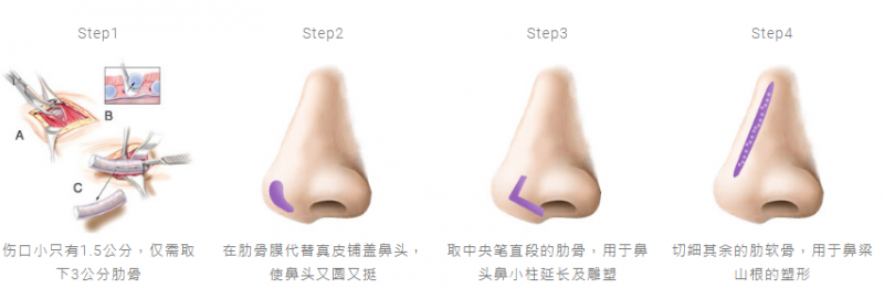 相较于传统肋骨隆鼻，珍珠肋骨鼻雕手术的优势有哪些？
