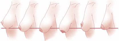 大胸平胸下垂怎么办？怎么自我判断乳房下垂的程度？