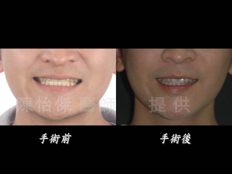 做正颚手术一定要配合牙齿矫正吗？
