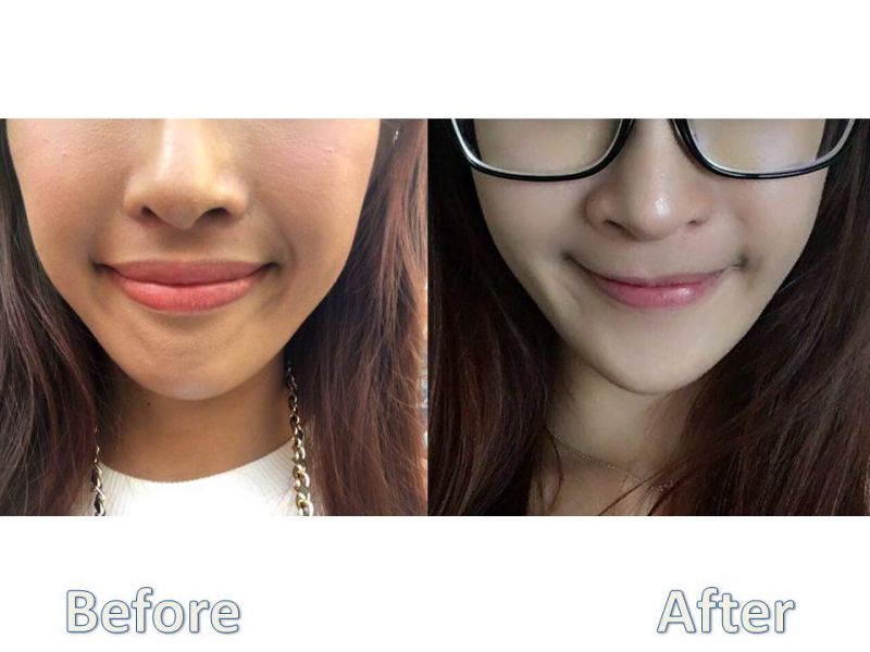 怎么利用上颚单颚手术改善唇型及笑容？效果好吗？