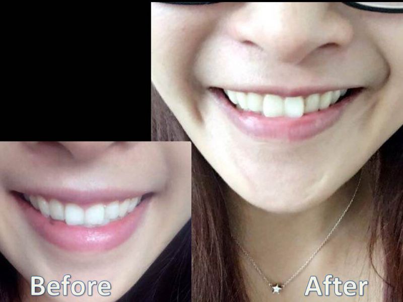 怎么利用上颚单颚手术改善唇型及笑容？效果好吗？