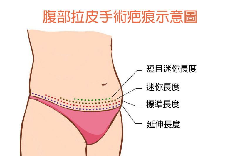 腹部拉皮手术时间多久？腹部拉皮能有效改善妊娠纹吗？