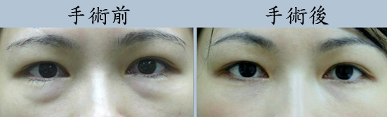 无疤眼袋脂肪移位手术效果怎么样？深入了解无疤眼袋脂肪移位方式