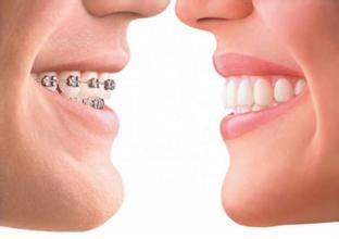 超声洁牙之后应该如何护理?