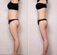 吸脂瘦小腿的三种方法比较
